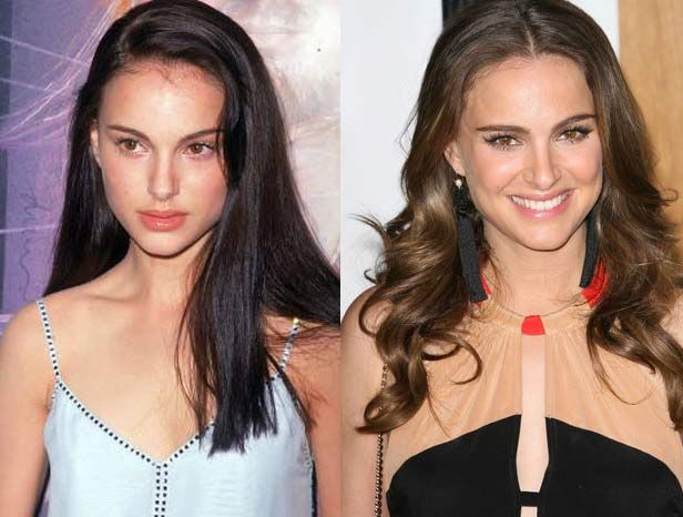 chirurgie-nez-lifting-portman