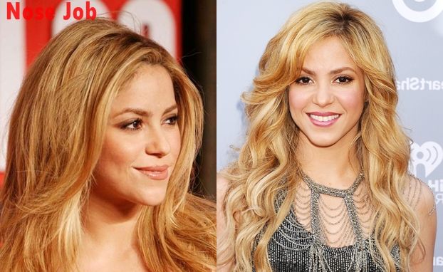Shakira-rhinoplastie
