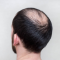 greffe-cheveux-tonsure