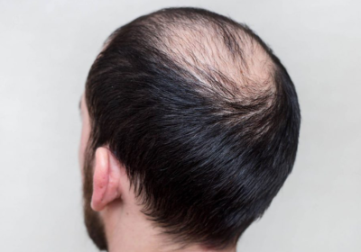 greffe-cheveux-tonsure