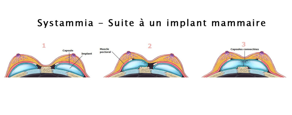 Systammia-suite-a-implant-mammaire-1